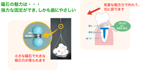 磁石の魅力は・・・強力な固定ができ、しかも歯にやさしい